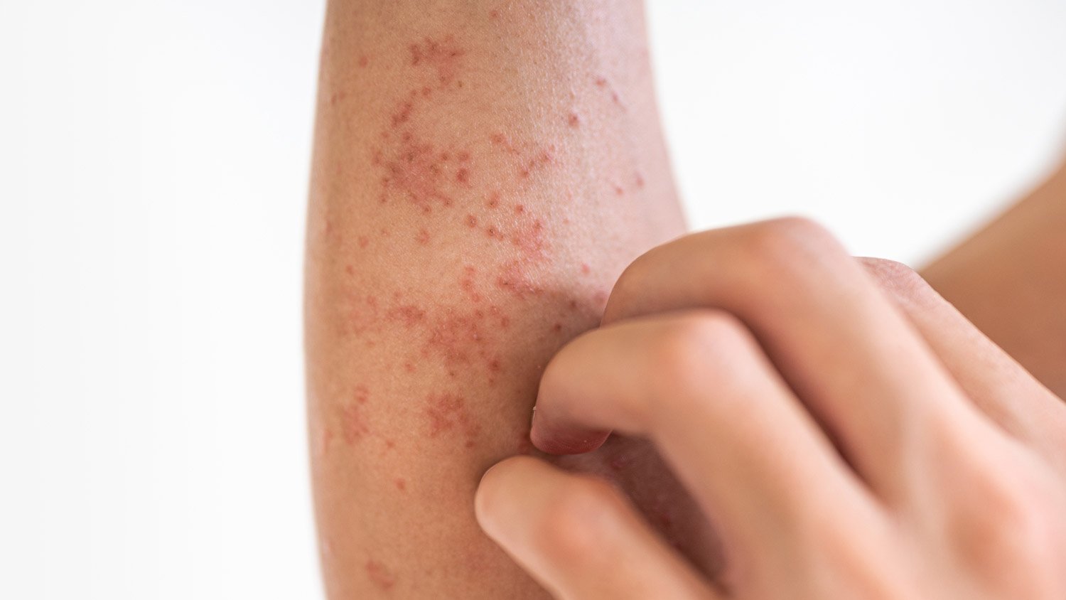 allergy allergy